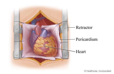 Retractor exposing the heart in the chest