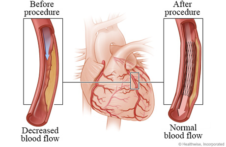 Decreased blood flow caused by narrowed artery before angioplasty compared to normal blood flow after angioplasty