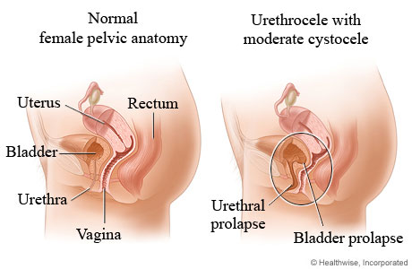 Urethrocele.