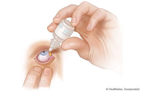 Pulling the lower eyelid down to create a small pouch and inserting eyedrops.