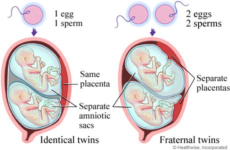 Twin pregnancy types.