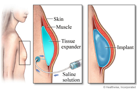 Breast Implant Surgery for Breast Reconstruction Oncology for