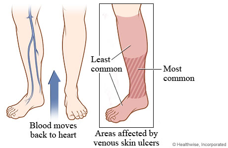 Leg and foot areas affected by venous skin ulcers