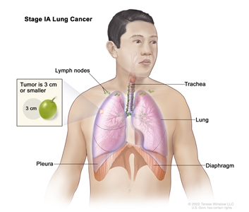 Stage IA lung cancer; drawing shows a tumor (3 cm or smaller) in the right lung. Also shown are the lymph nodes, trachea, pleura, and diaphragm.
