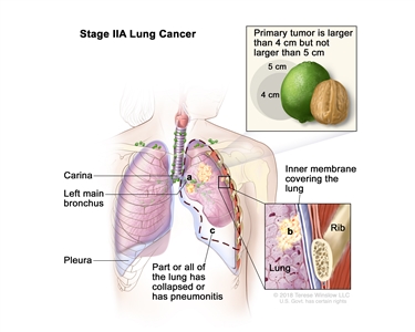 Stage IIA lung cancer; drawing shows a primary tumor (larger than 4 cm but not larger than 5 cm) in the left lung and cancer in (a) the left main bronchus and (b) the inner membrane covering the lung (inset). Also shown is (c) part or all of the lung has collapsed or has pneumonitis (inflammation). The carina, pleura, and a rib (inset) are also shown.
