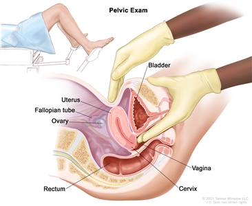 Pelvic exam; drawing shows a side view of the female reproductive anatomy during a pelvic exam. The uterus, left fallopian tube, left ovary, cervix, vagina, bladder, and rectum are shown. Two gloved fingers of one hand of the doctor or nurse are shown inserted into the vagina, while the other hand is shown pressing on the lower abdomen. The inset shows a woman covered by a drape on an exam table with her legs apart and her feet in stirrups.