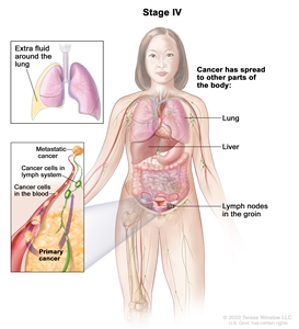 Drawing of stage IV shows other parts of the body where ovarian cancer may spread, including the lung, liver, and lymph nodes in the groin. An inset on the top shows extra fluid around the lung. An inset on the bottom shows cancer cells spreading through the blood and lymph system to another part of the body where metastatic cancer has formed.