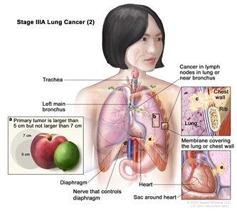 Stage IIIA lung cancer (2); drawing shows (a) a primary tumor (larger than 5 cm but not larger than 7 cm) in the left lung and cancer in lymph nodes in the lung or near the bronchus on the same side of the chest as the primary tumor. Also shown is (b) separate tumors in the same lobe of the lung as the primary tumor and cancer that has spread to (c) the chest wall and the membranes covering the lung and chest wall (top right inset); (d) the nerve that controls the diaphragm; and (e) the sac around the heart (bottom right inset). The trachea, left main bronchus, diaphragm, heart, and a rib (top right inset) are also shown.
