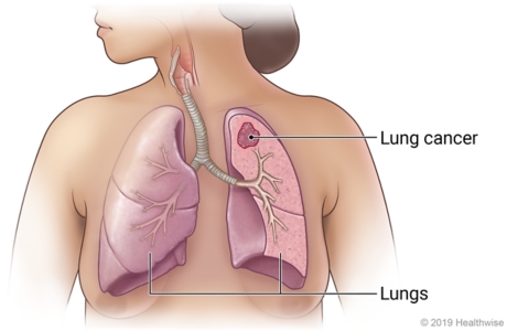 Location of lungs in chest, showing lung cancer in upper lobe of a lung