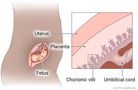 Fetus in uterus, with detail of placenta showing the chorionic villi and umbilical cord