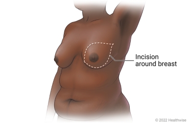 Breast, showing outline of incision around breast for mastectomy.