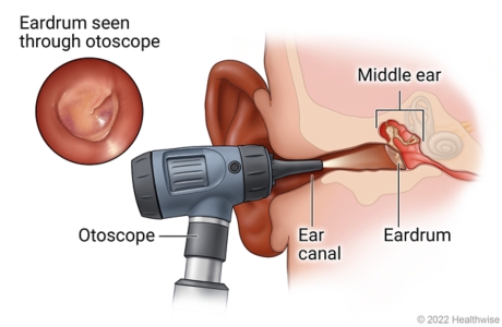 Otoscope in ear canal, showing location of eardrum and middle ear and detail of eardrum seen through otoscope.