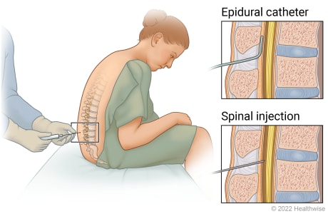 Needle inserted near spinal cord in seated person's back, with details of spinal injection site and epidural catheter placement.