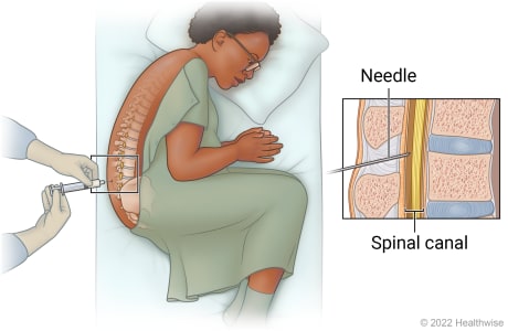 Person lying on side with knees pulled up toward chest getting lumbar puncture, with detail of needle inserted into spinal canal.
