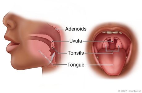Side and open-mouth views of throat and mouth, showing adenoids, uvula, tonsils, and tongue.