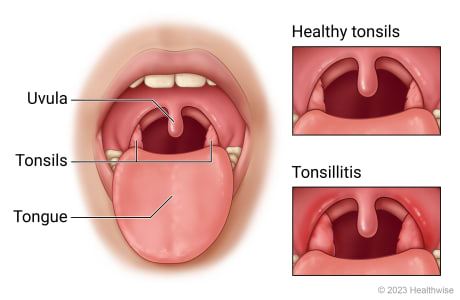 Open mouth showing uvula, tonsils, and tongue, with detail of healthy tonsils and tonsils red and swollen with tonsillitis.