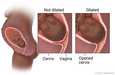 Head of fetus down near cervix before birth, with detail of cervix closed and detail of cervix open (dilated) as delivery nears.