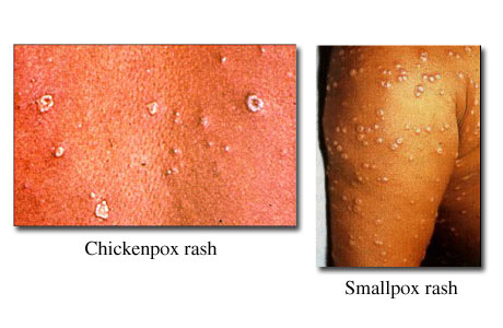 Chickenpox and smallpox rashes