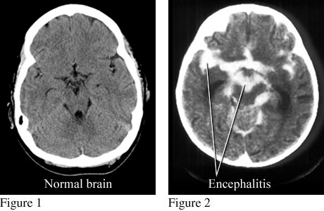 CT scans of normal brain and brain with encephalitis
