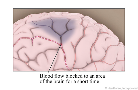 Blood flow blocked to an area of the brain for a short time.