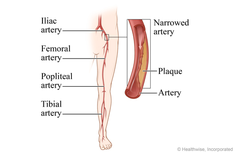 Peripheral arteries of the leg, with detail of the iliac artery narrowed by plaque.