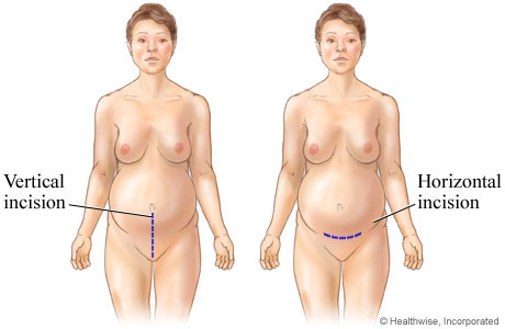 Picture of C-section incisions