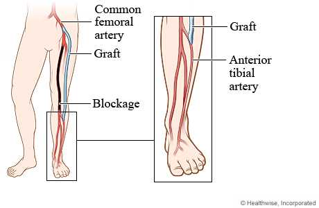 Blocked artery and position of graft in femoral-tibial bypass surgery.