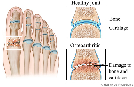 Healthy joint and osteoarthritis of the foot