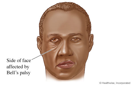 Facial muscles affected by Bell's palsy