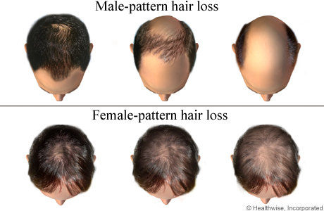 Progression of inherited hair loss in men and women