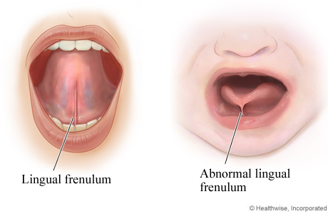 Picture of a normal and an abnormal lingual frenulum