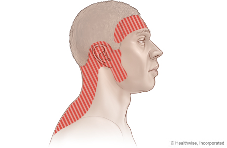 Possible areas of pain with tension headache