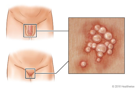 Location of genital herpes, with close-up of blisters