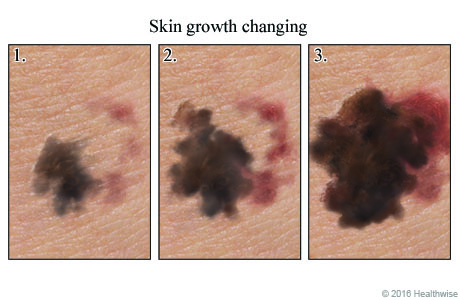 Three images that show a skin growth getting larger over time