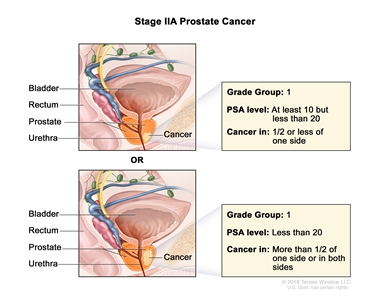 Two-panel drawing of stage IIA prostate cancer; the top panel shows cancer in one-half or less of one side of the prostate. The PSA level is at least 10 but less than 20 and the Grade Group is 1. The bottom panel shows cancer in more than one-half of one side of the prostate. The PSA level is less than 20 and the Grade Group is 1. In both panels, the bladder, rectum, and urethra are also shown.