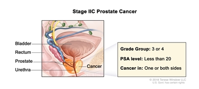 Stage IIC prostate cancer; drawing shows cancer in both sides of the prostate. The PSA level is less than 20 and the Grade Group is 3 or 4. Also shown are the bladder, rectum, and urethra.