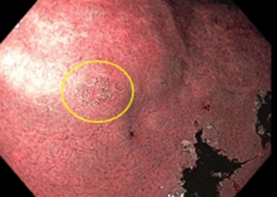 Endoscopic image showing a small area of intestinal metaplasia (circled in yellow) in the antrum of the stomach.