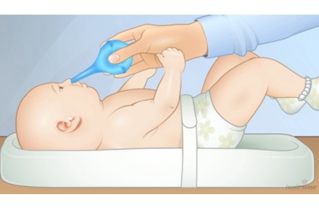 Using a Rubber Bulb to Clear a Baby's Nose