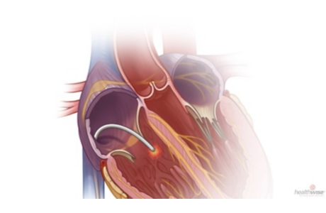 Catheter Ablation for SVT: Before Your Procedure