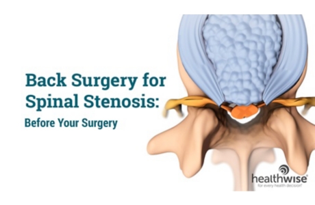 Back Surgery for Spinal Stenosis: Before Your Surgery