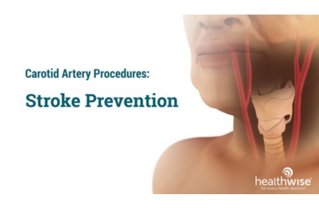 Carotid Artery Procedures: Stroke Prevention