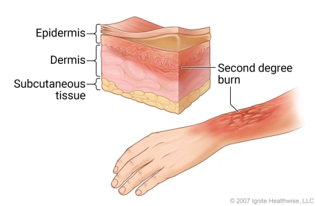 Second-degree burn on arm, with cross-section of skin showing redness and swelling in top two skin layers.