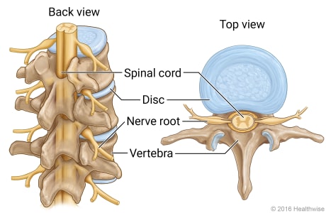 Back view and top view of section of spine, showing discs, spinal cord, nerve roots, and vertebrae