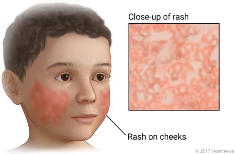 Fifth disease rash on face, with close-up of second-stage body rash.