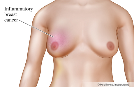 Inflammatory breast cancer