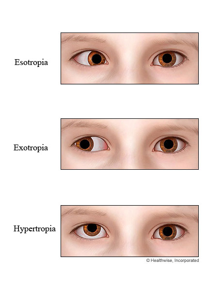 Types of strabismus