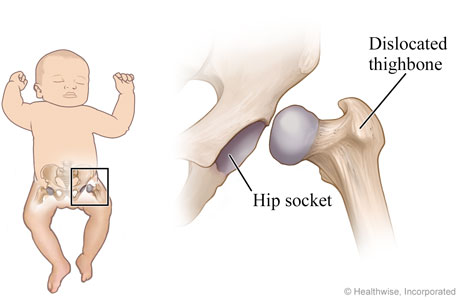 Hip dysplasia baby treatment hotsell