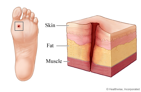 Picture of a puncture wound