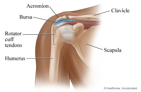 Bursitis of the shoulder