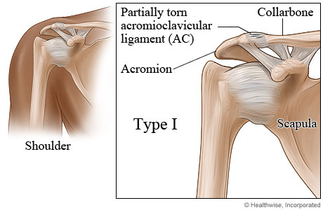 Type I shoulder separation